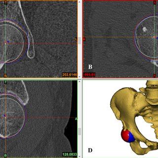 acetabular reaming technique|Effects of the depth of the acetabular component during simulated .